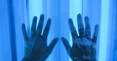 Vitiligo_NB-UVB_treatment
