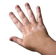 Vitiligo_hand