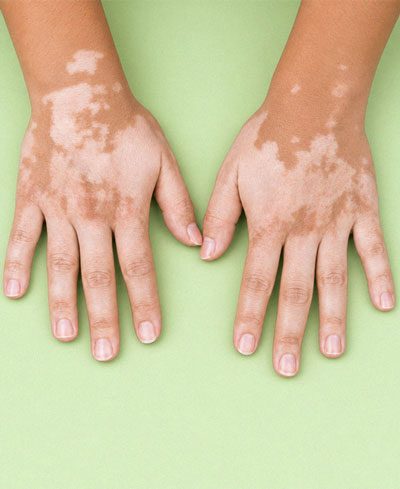 vitiligo_skinmedical_hands